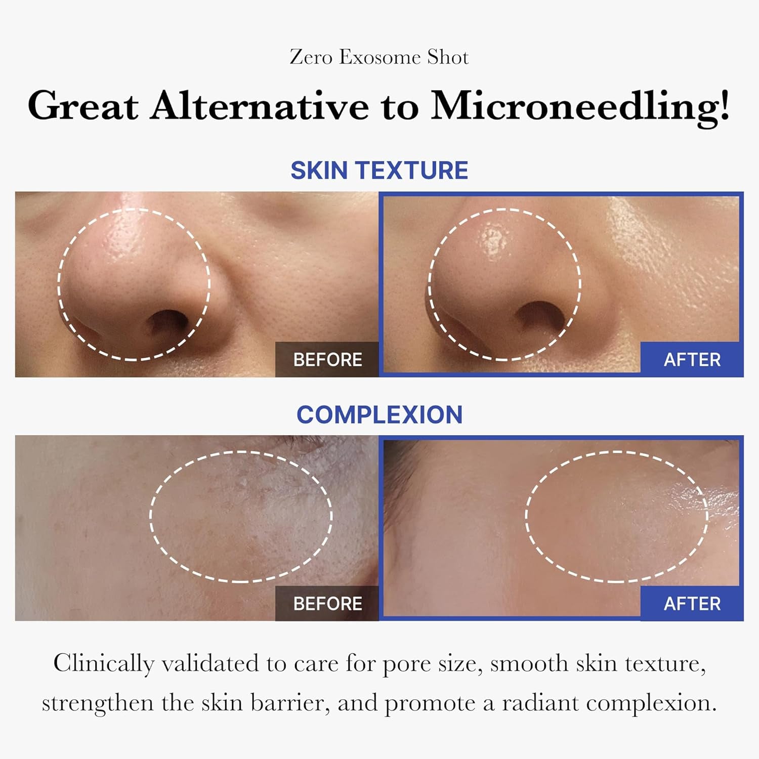 Revitalize Your Skin with Zero Exosome Shot Facial Serum! π 2,000 PPM Liquid Booster for Pore Perfection & Smooth Texture π§β¨ #KoreanSkincare #GlowUp