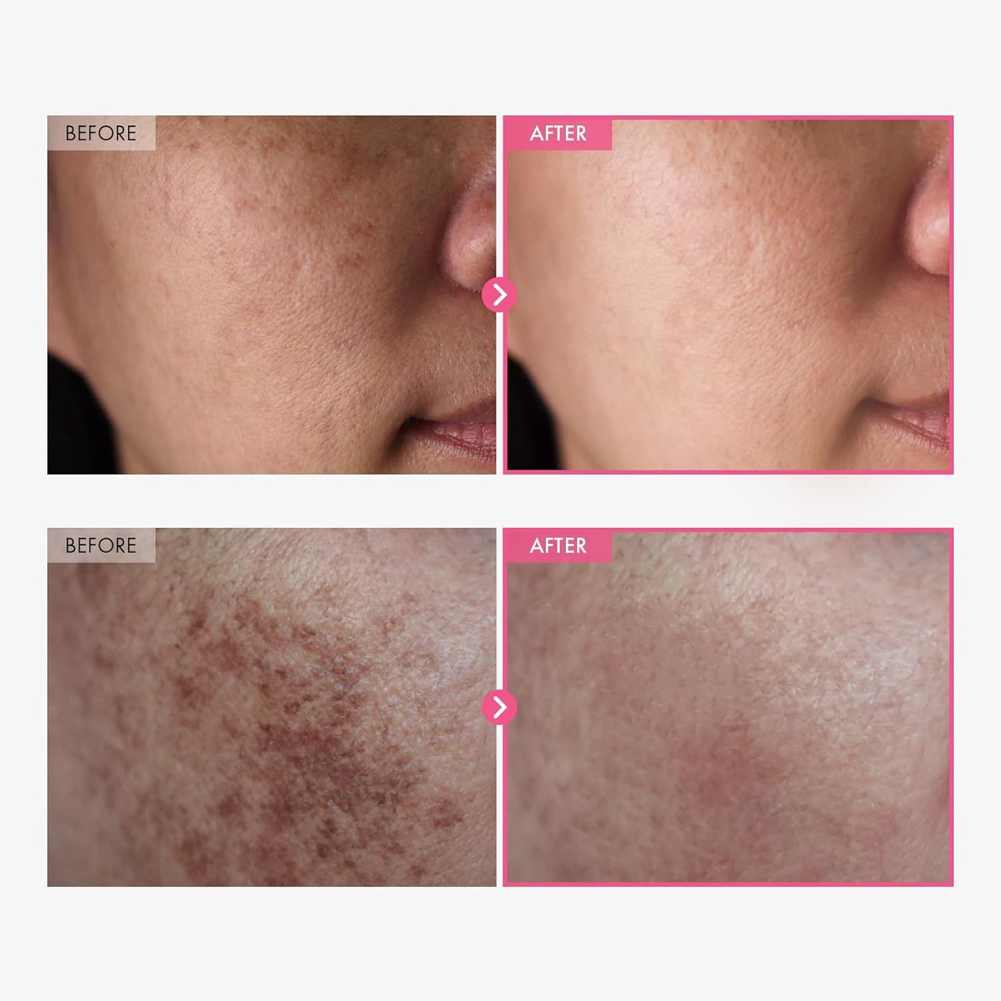 Say goodbye to dark spots! 🌟 Try our powerful Arbutin & Tranexamic Acid Cream with Niacinamide and Glutathione for radiant skin! 💖 50ml of skin-loving goodness!