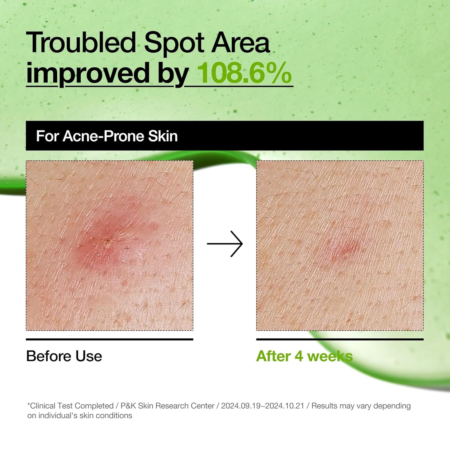 Soothing Serum for Sensitive Skin: Azelaic Acid 10% & Hyaluronic Acid with Niacinamide - Vegan Korean Skincare! πΏπ§ #SkincareGoals #SensitiveSkin