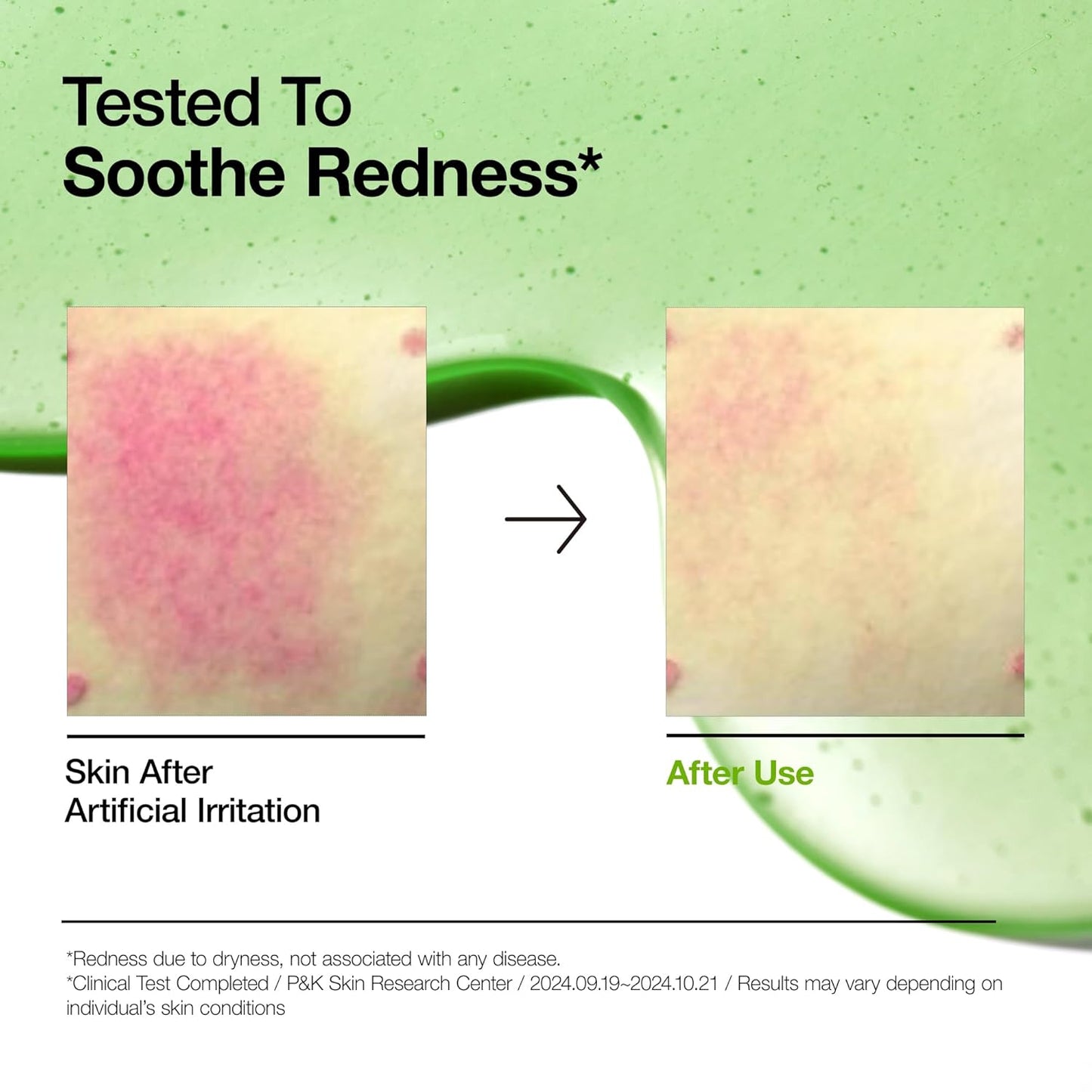 Soothing Serum for Sensitive Skin: Azelaic Acid 10% & Hyaluronic Acid with Niacinamide - Vegan Korean Skincare! πΏπ§ #SkincareGoals #SensitiveSkin