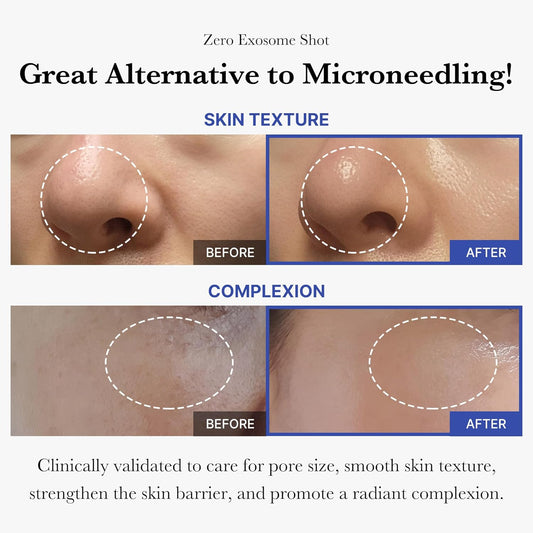 Revitalize Your Skin with Zero Exosome Shot Facial Serum! 🌟 2,000 PPM Liquid Booster for Pore Perfection & Smooth Texture 💧✨ #KoreanSkincare #GlowUp